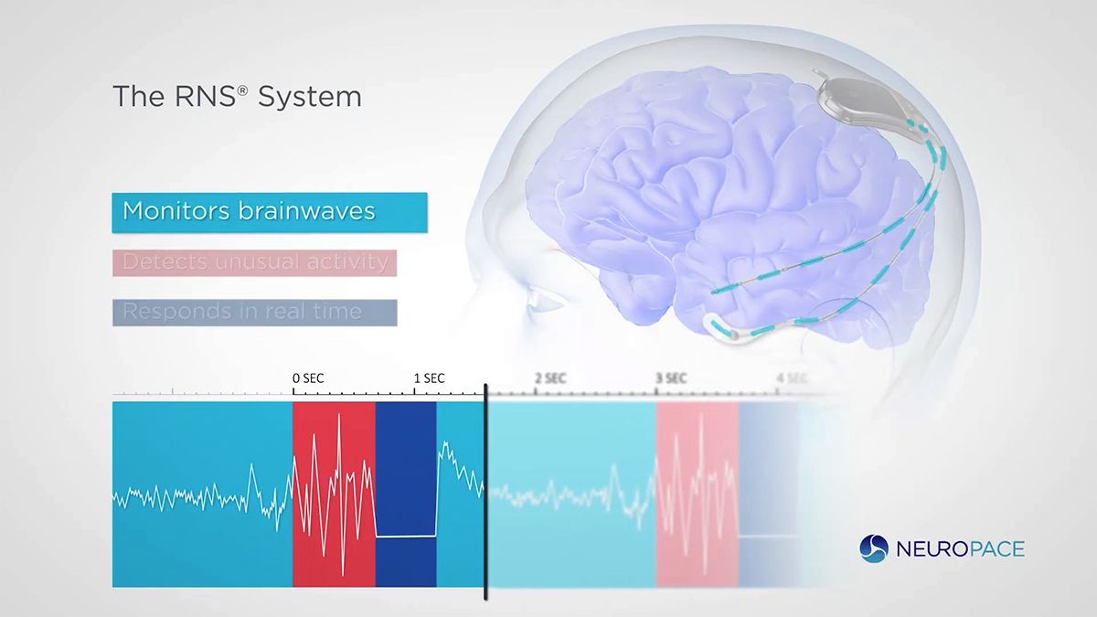 NeuroPace社のRNSシステム。同社YouTubeより     
